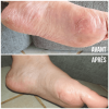 Moisturizing slippers to fight against Hand-foot syndrome - MÊME Cosmetics