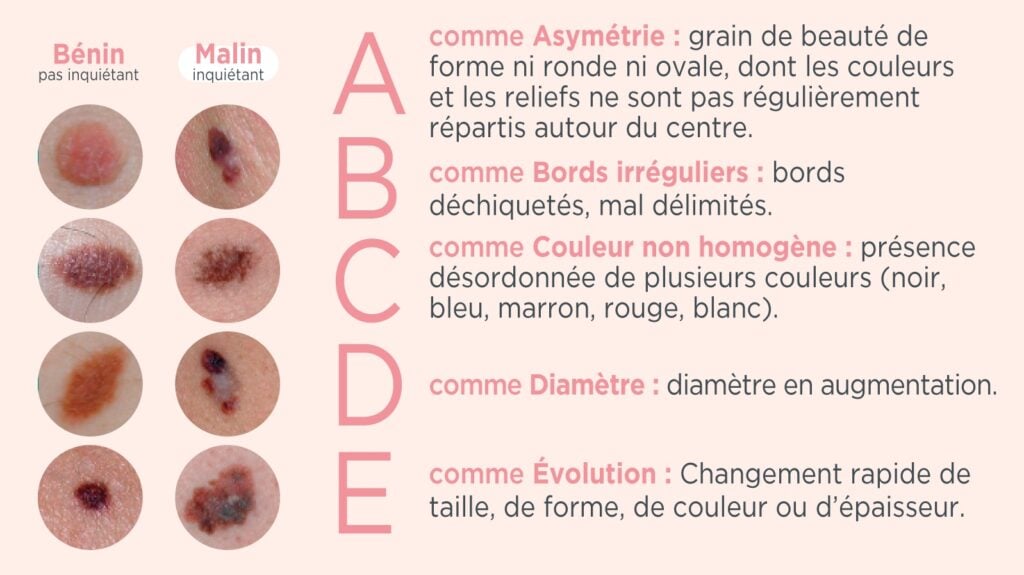 cancer-peau-symptômes-mélanome-même-cosmetics