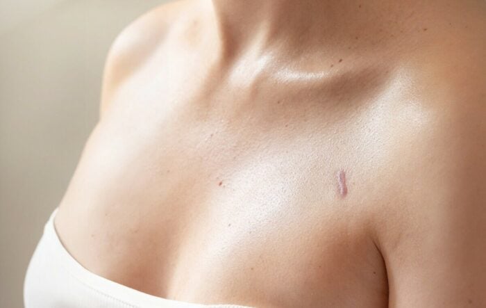 Tout savoir sur le cancer du sein triple négatif