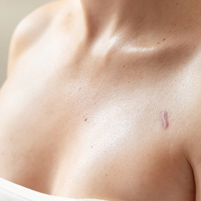 Tout savoir sur le cancer du sein triple négatif