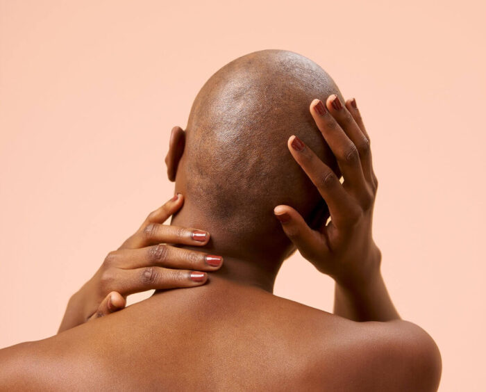 Cancer : préparer la chute de mes cheveux