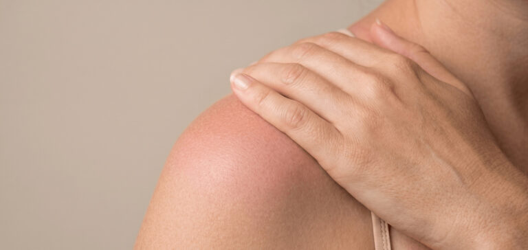 coups de soleil apaiser la peau MÊME