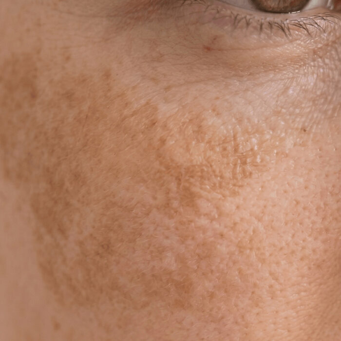 Tâches de soleil sur le visage : comment les prévenir et les atténuer ?