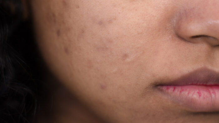 Effets du soleil sur la peau : les comprendre pour mieux se protéger