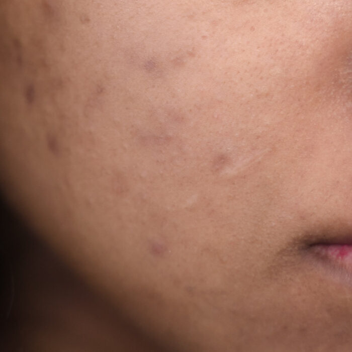 Effets du soleil sur la peau : les comprendre pour mieux se protéger