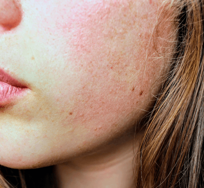 Peau réactive qui rougit : causes et solutions pour l’apaiser